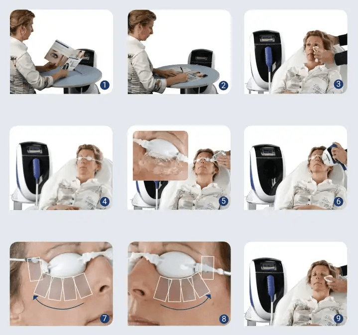 Terapia syndrómu suchého oka